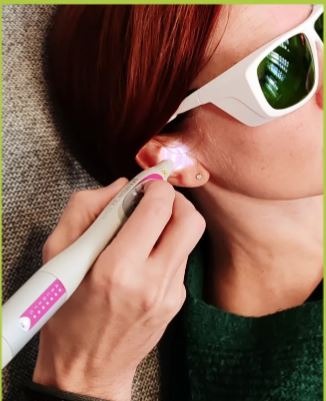 photo seance Tatérapi Laser La Rochelle - île de Ré