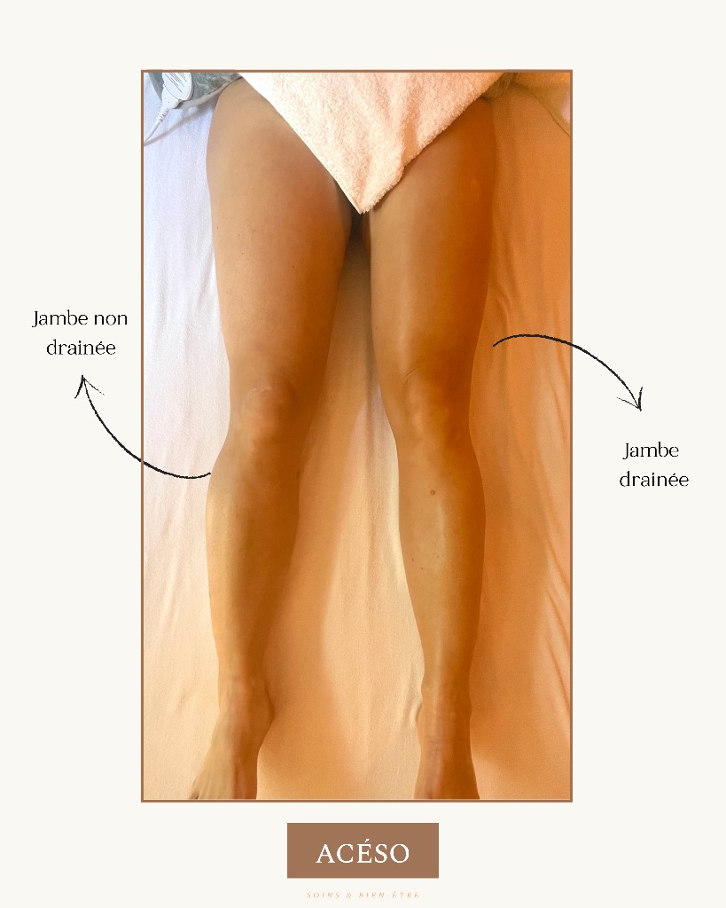 photo activite Aceso Drainage 