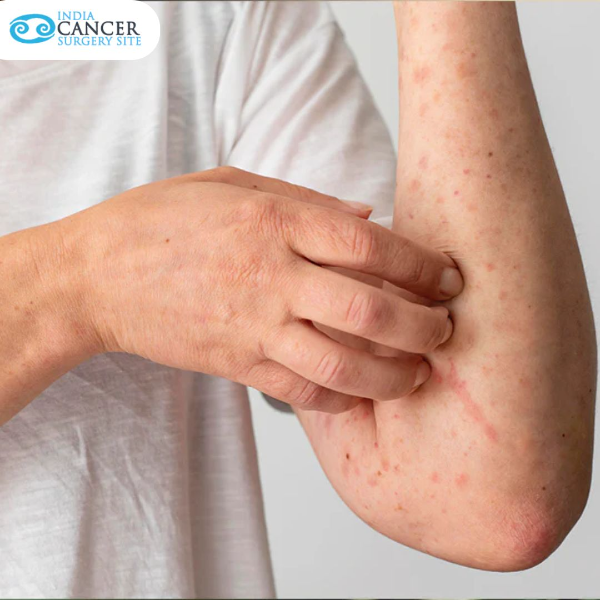 Traitement du cancer de la peau en Inde