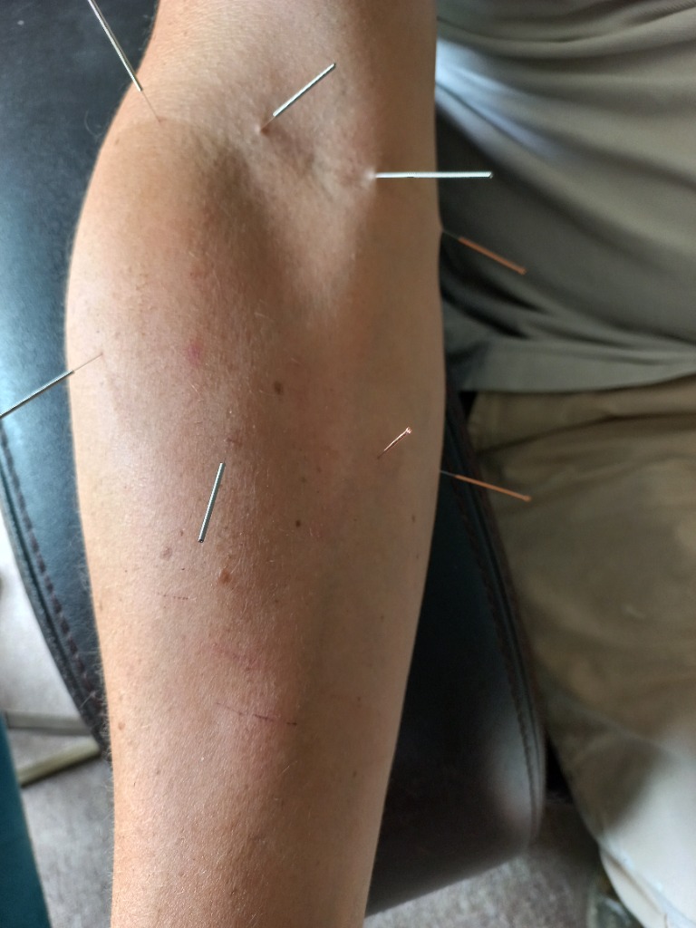 photo seance Hervé RICHET ACUPUNCTEUR