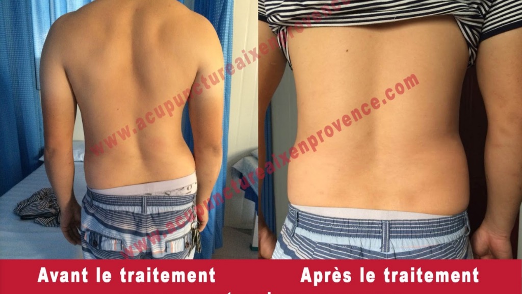 photo seance Tianran Liyun Wang, Fascia Thérapie Acupuncture