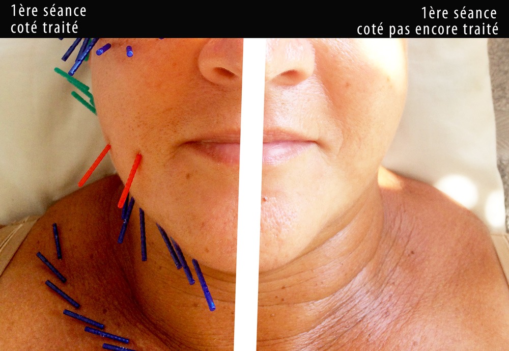 photo seance Centre d’acupuncture Sebastopol