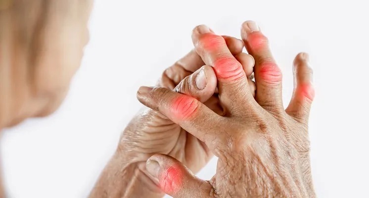 illustration L'arthrose