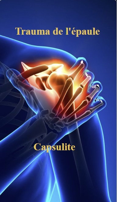 illustration Capsulite, traumatisme, pathologies de l'épaule.