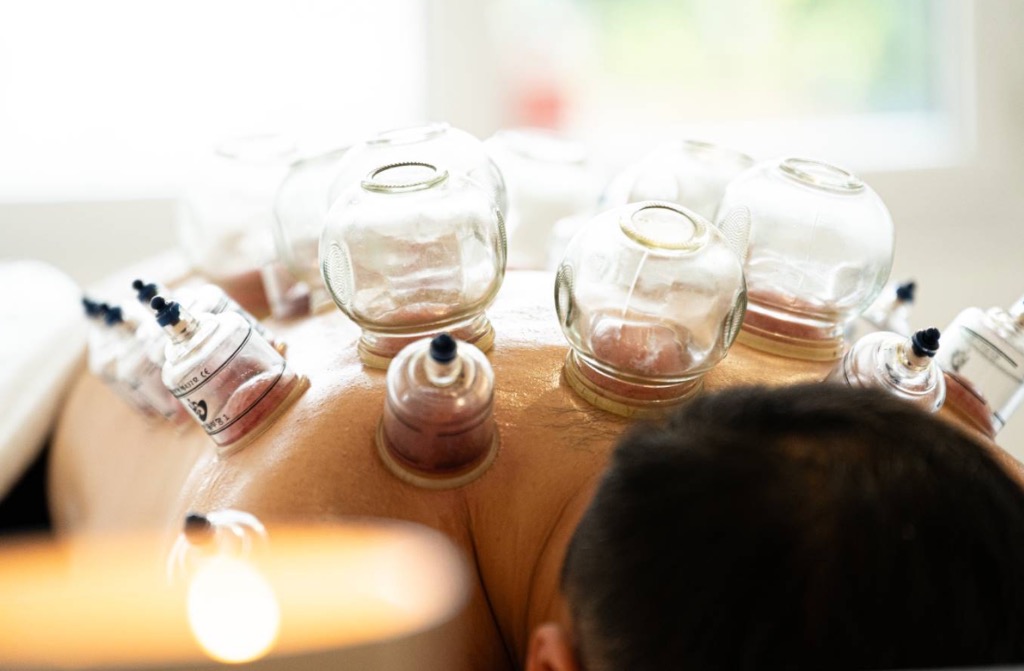 illustration Cupping / Hijama