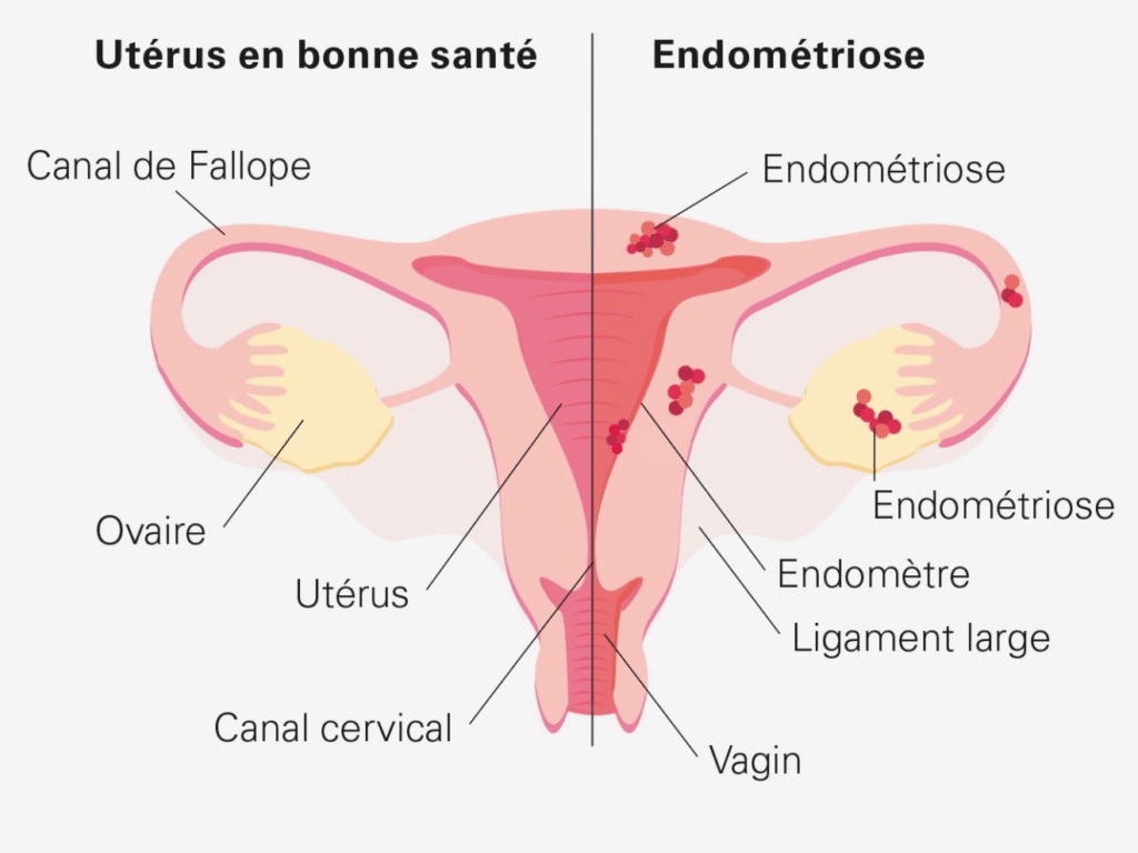 illustration ENDOMETRIOSE: l'alimentation peut aussi faire la différence