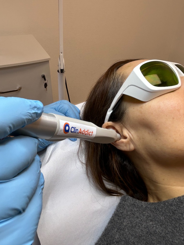 illustration L’auriculothérapie au laser doux une alternative pour traiter les addictions