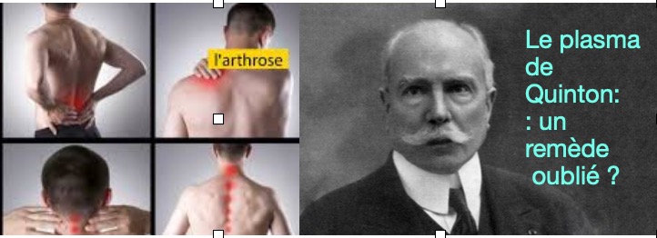illustration le plasma de quinton: un remède efficace contre les douleurs articulaires