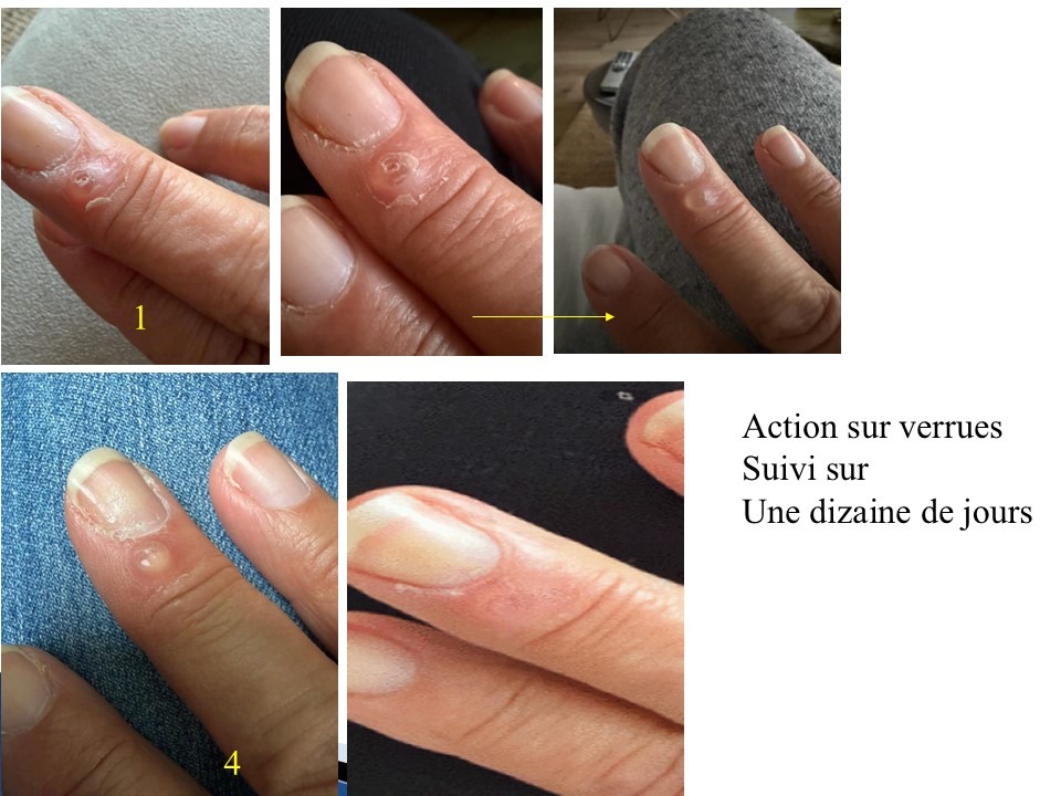 illustration magnétisme et verrue