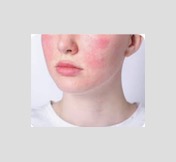 illustration L'ECZÉMA ET LE REIKI TRADITIONNEL